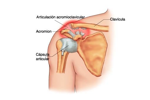 cirugia hombro acromioclavicular malaga